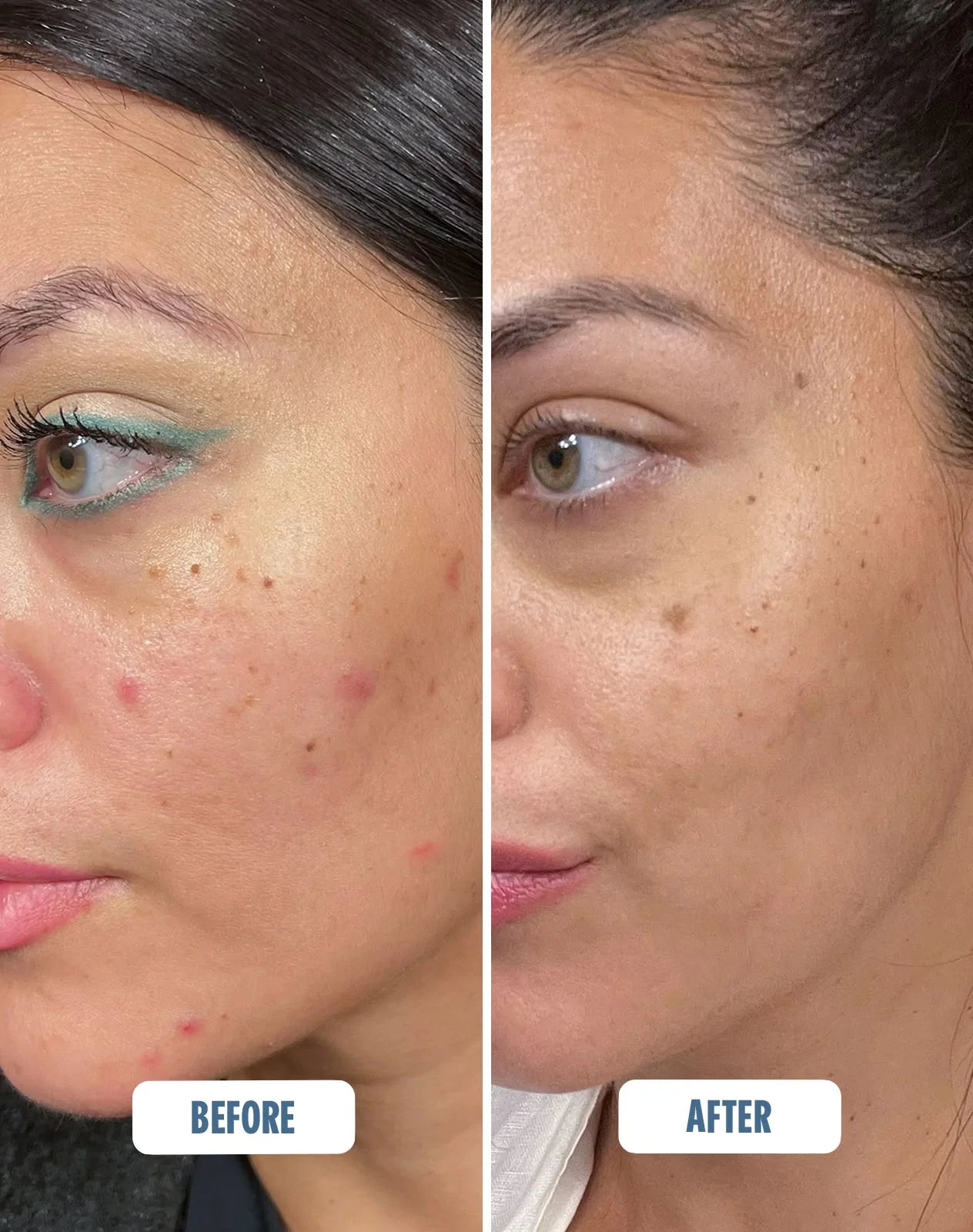 Mighty Mist - For Acne, Rosacea, Eczema - Hypochloros Acid Spray