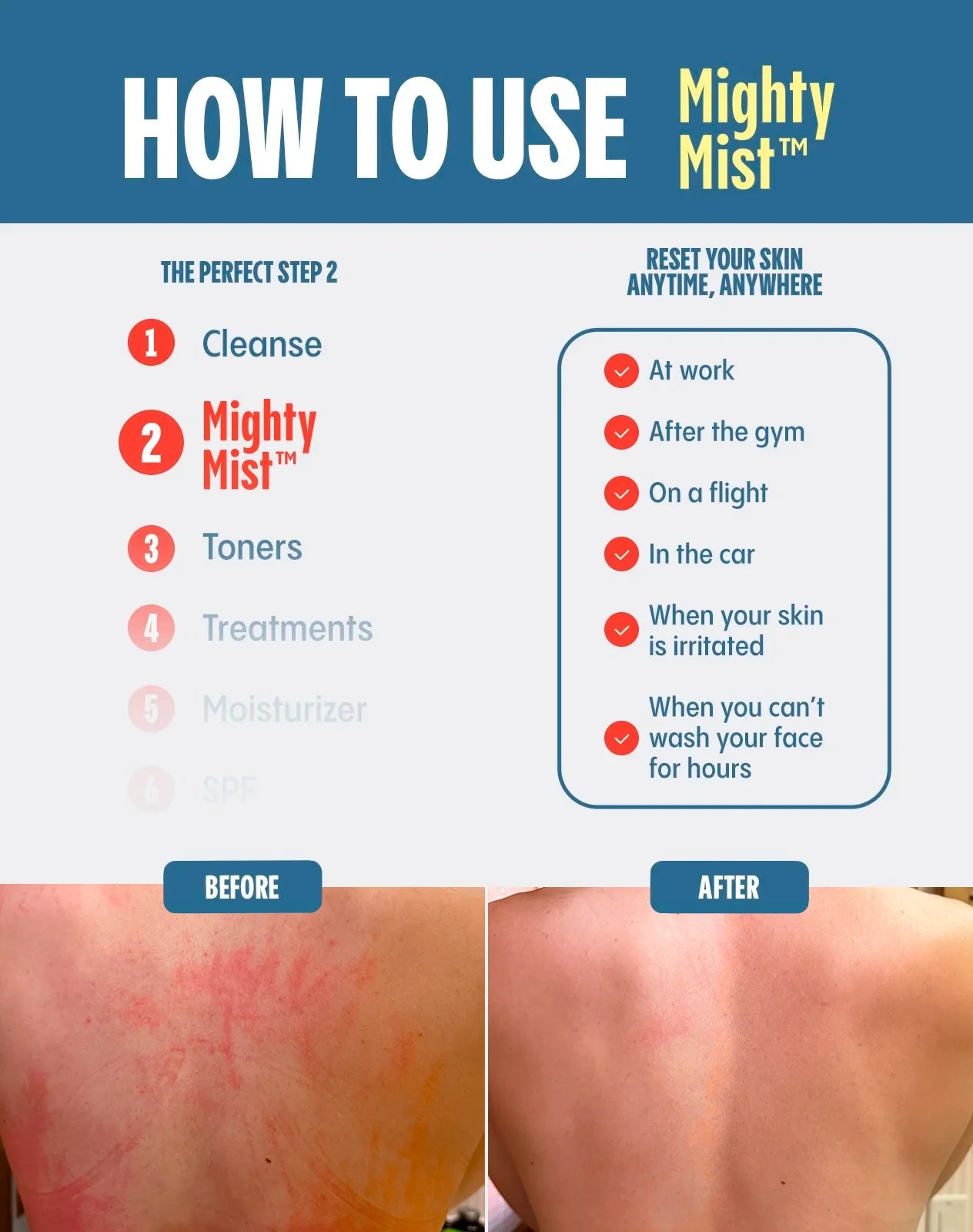 Mighty Mist - For Acne, Rosacea, Eczema - Hypochloros Acid Spray